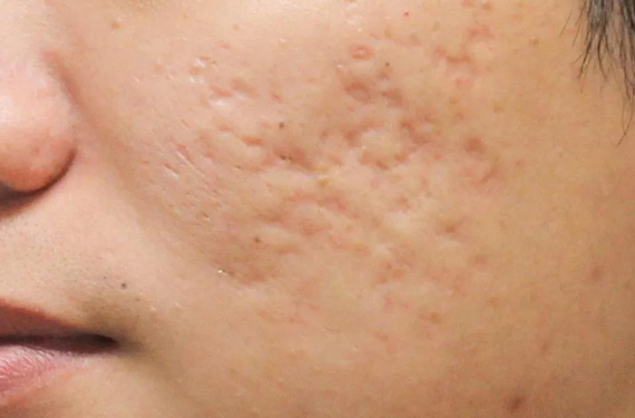 A face of a lady with Acne Scars