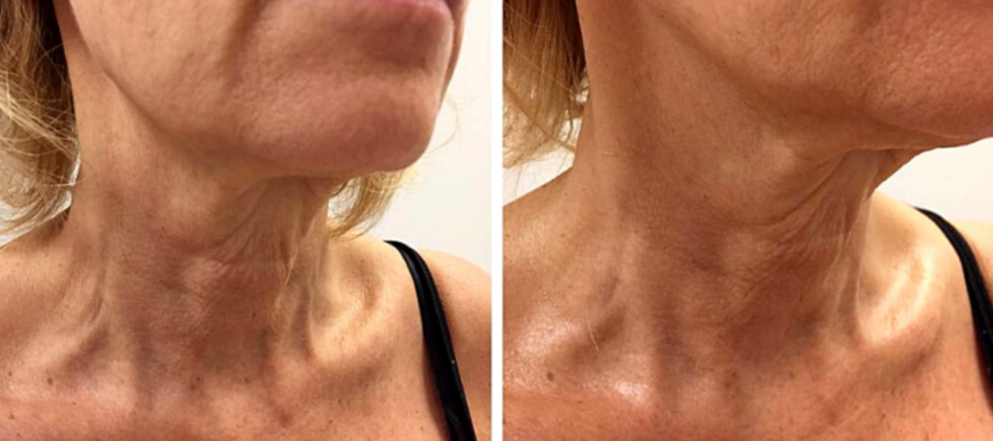 A lady with Wishpro Surgical Facelift treatment