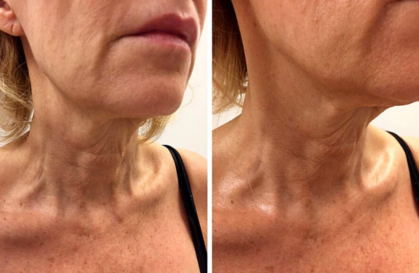 A lady with Wishpro Surgical Facelift treatment