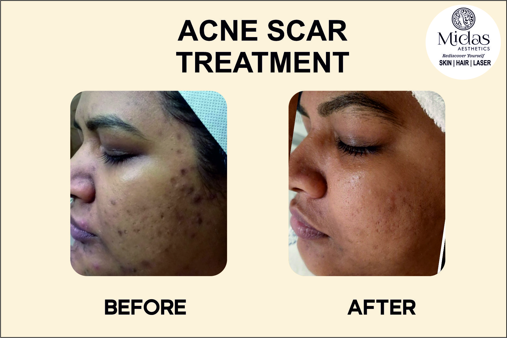 Acne Scar treatment before and after images