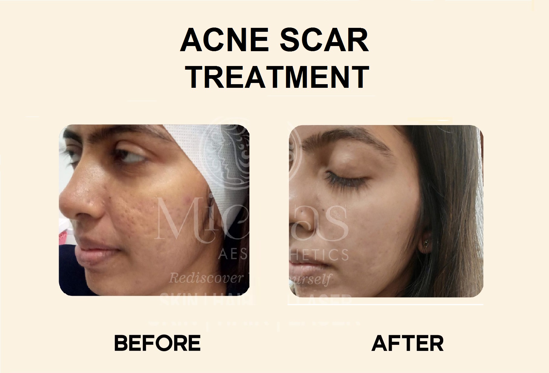 Acne Scar treatment, before and after images