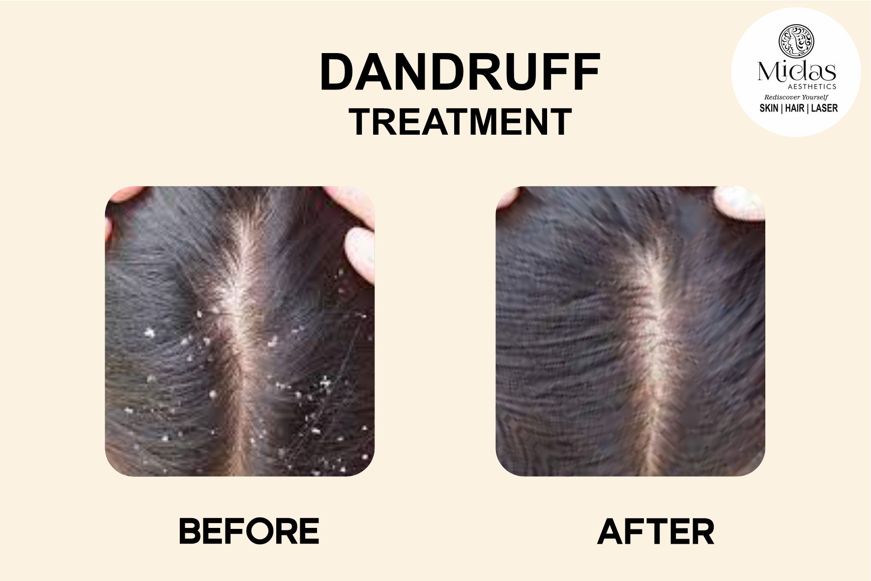 DANDRUFF Treatment before and after images