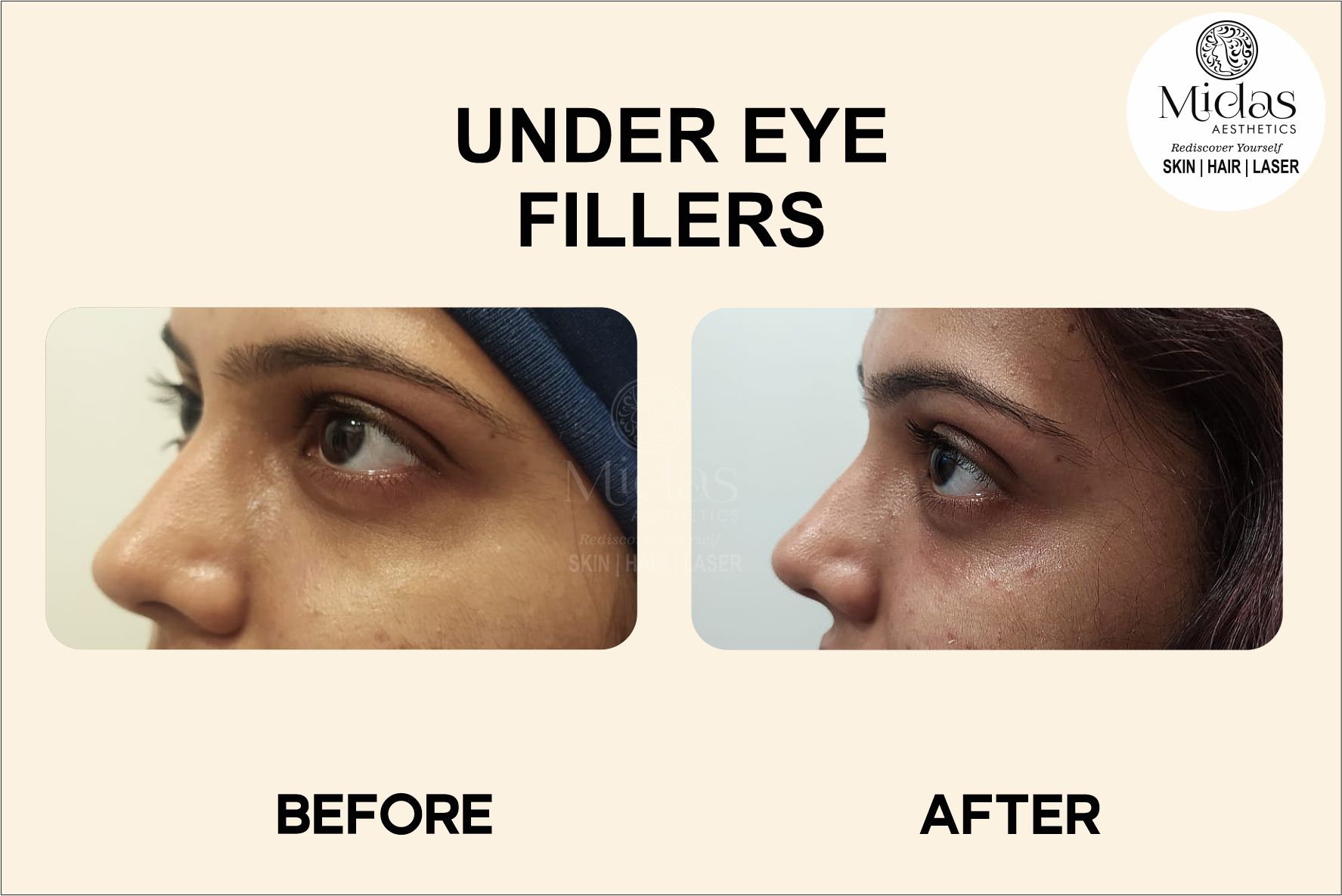 Under eye fillers treatment before and after images