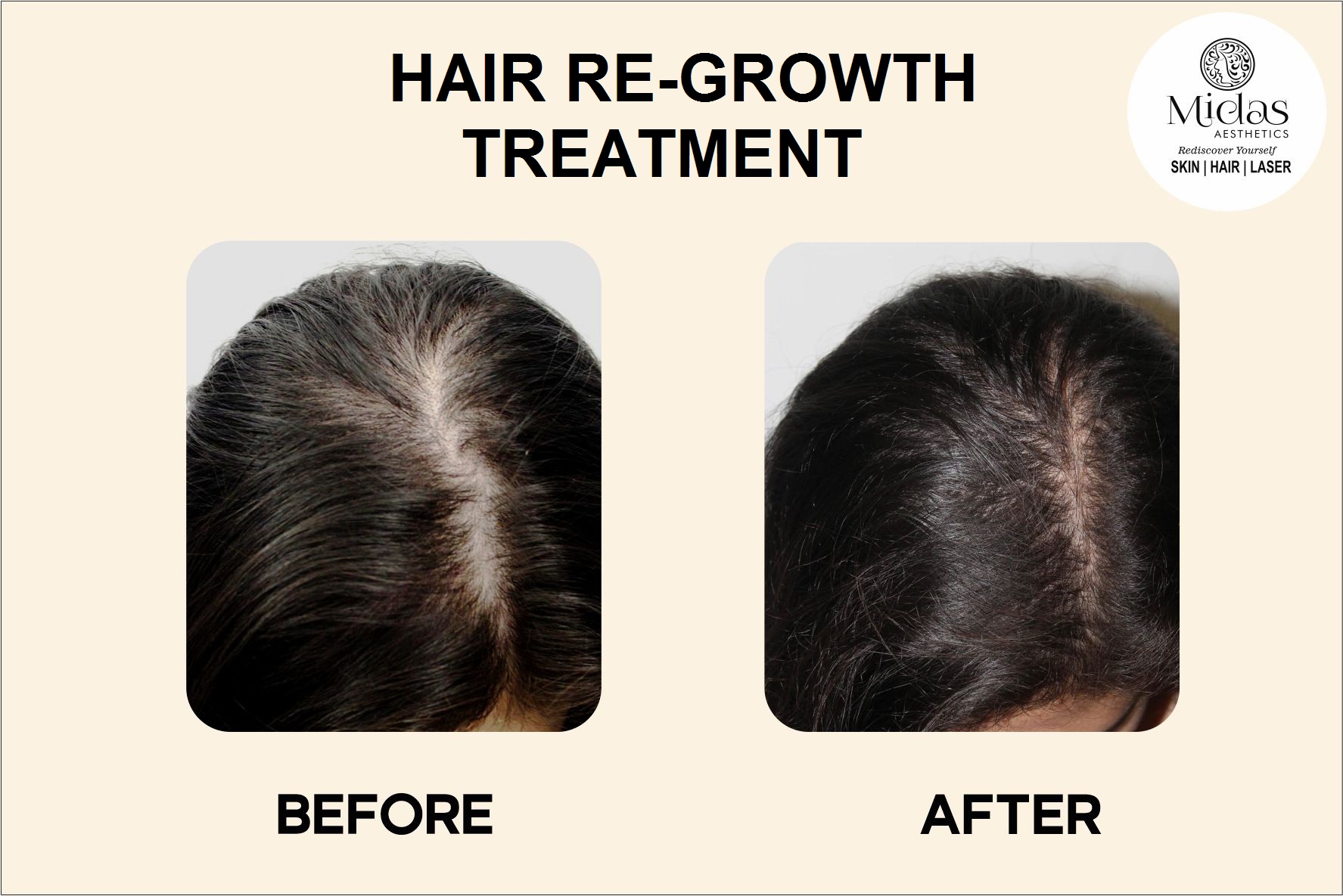 HAIR Re-growth treatment