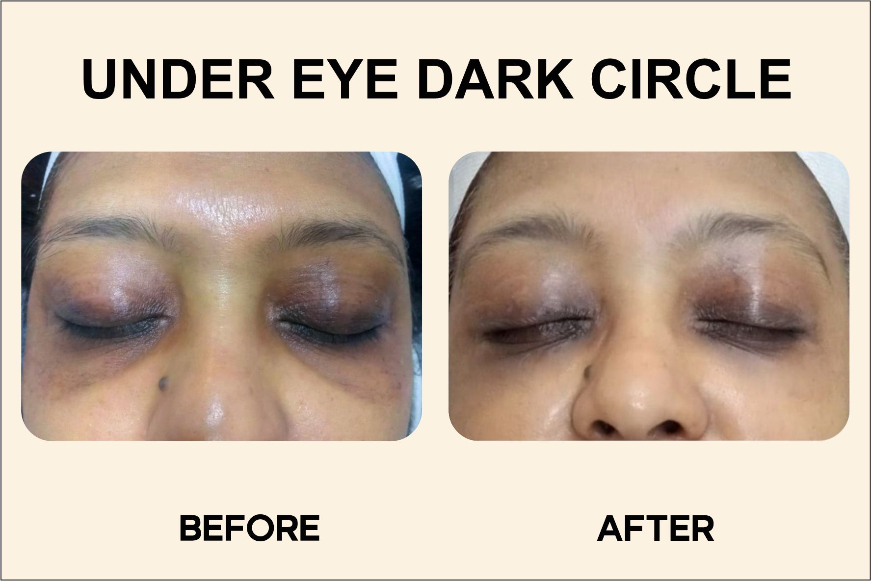 Under eye dark circle before and after images