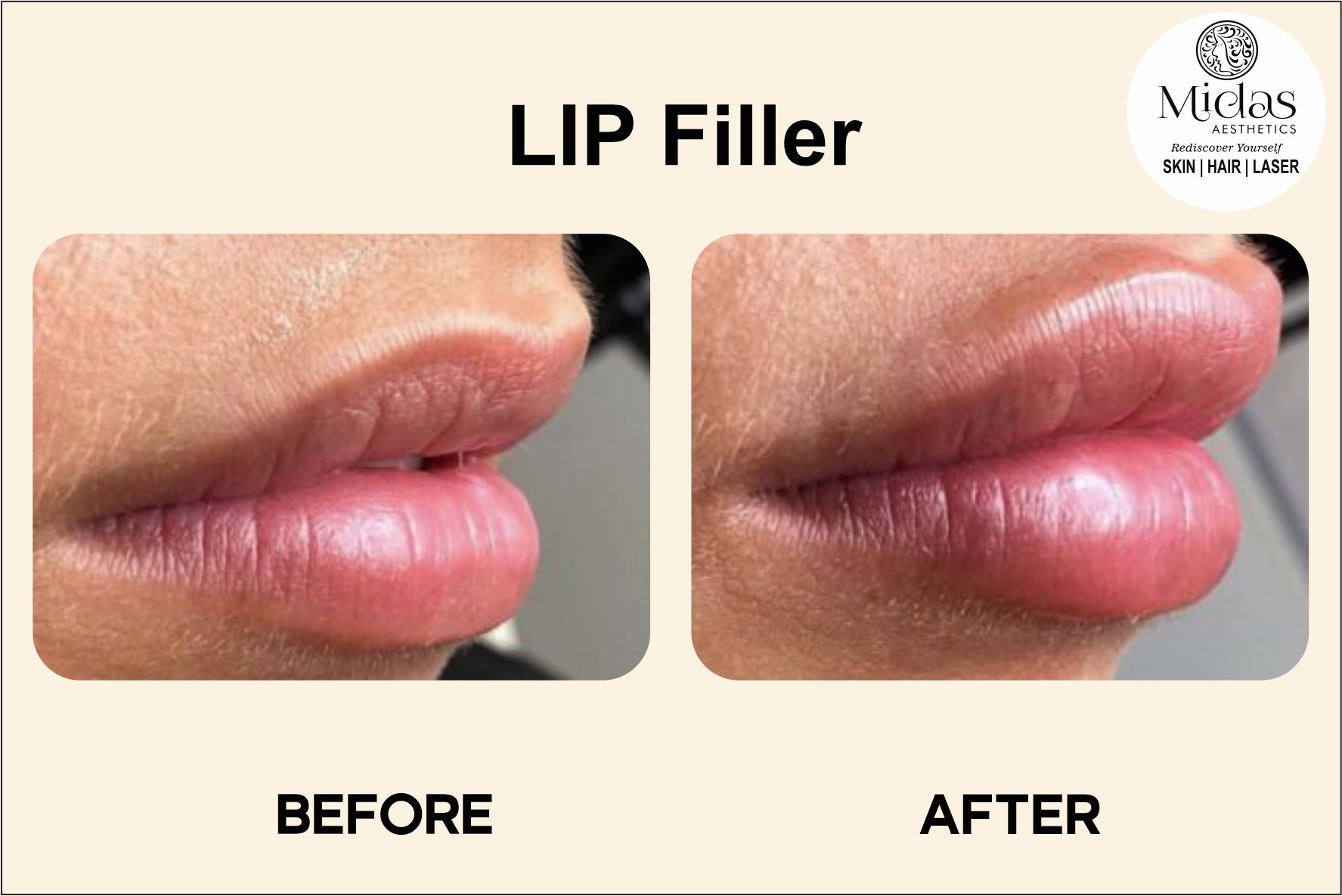Lip filler treatment before and after images