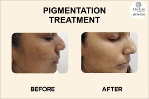Hyperpigmentation Treatment before and after images