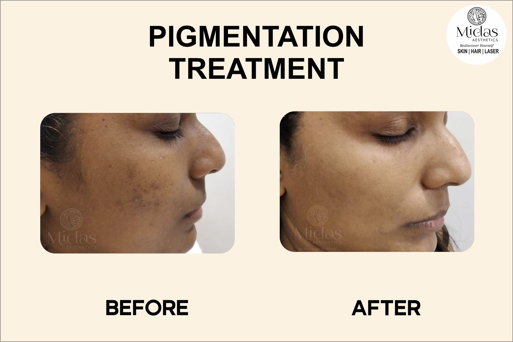 Hyperpigmentation Treatment before and after images - Laser Treatment for Pigmentation - Midas Wellness Hub