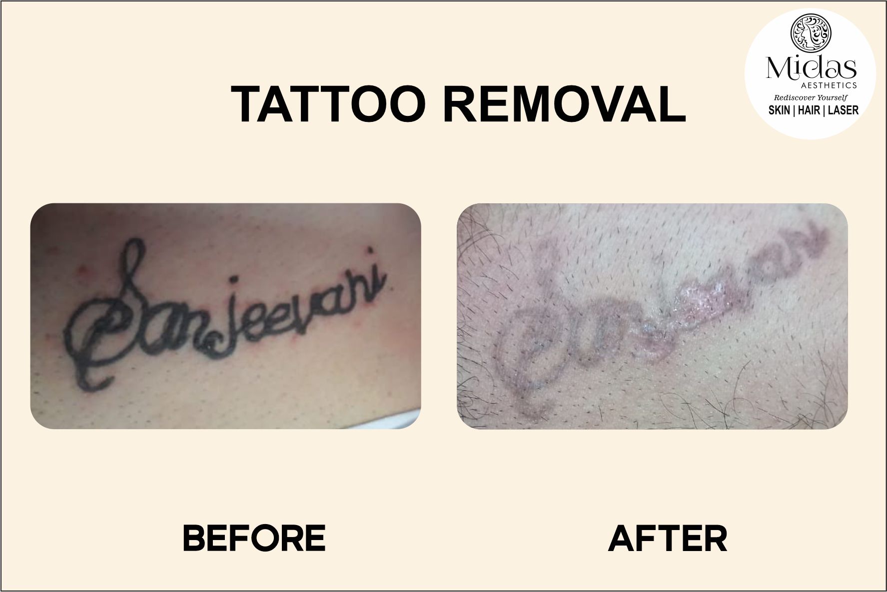 Tattoo Removal, before and after images