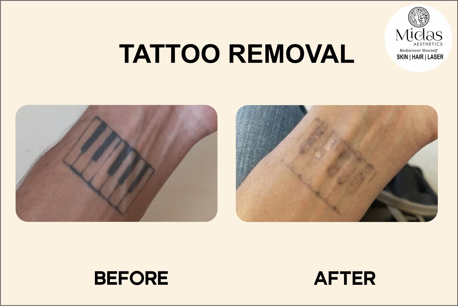 Tattoo Removal before and after images