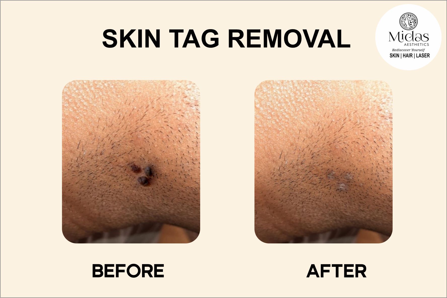 SKIN TAG Removal before and after images