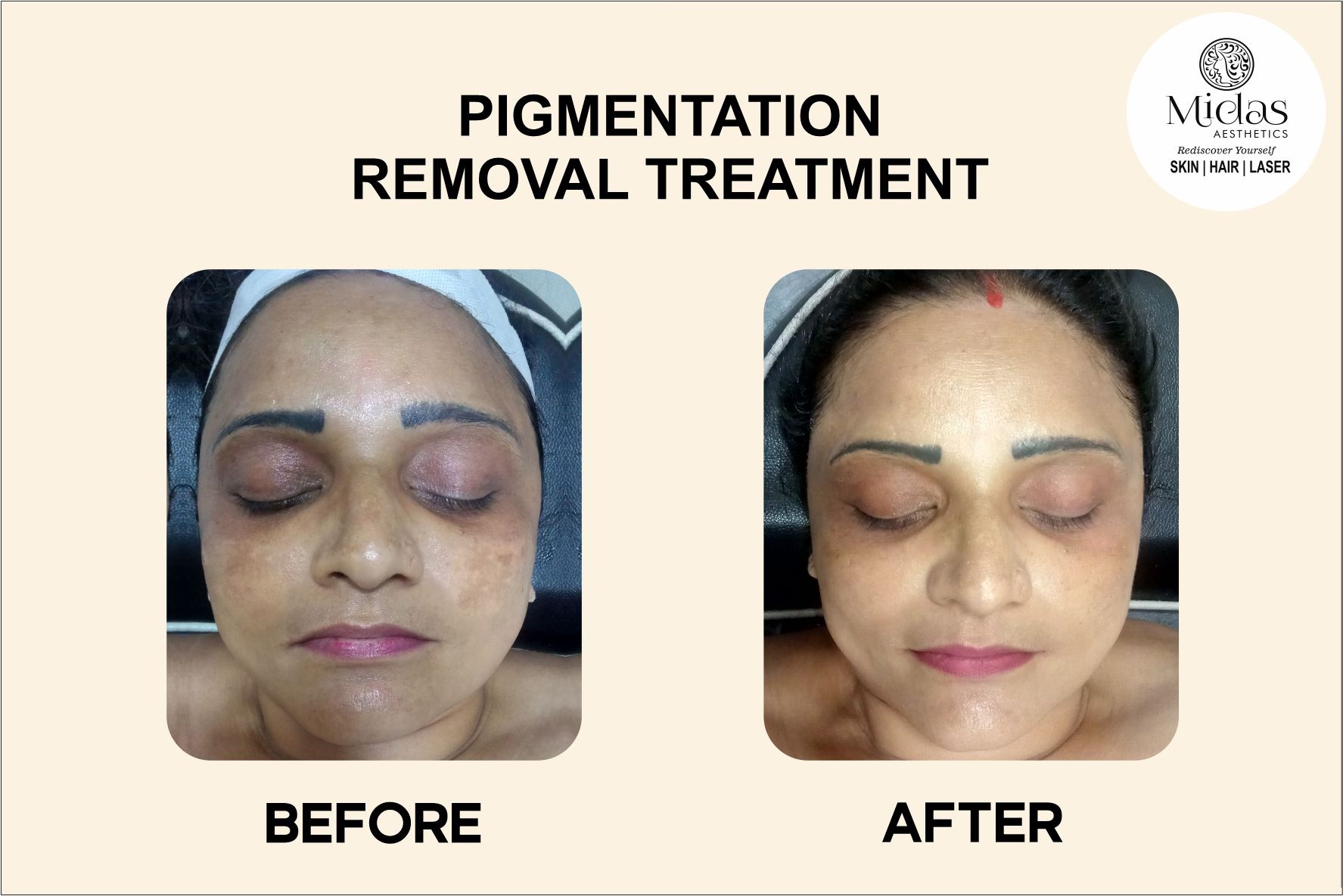 Pigmentation removal treatment before and after images - Laser Treatment for Pigmentation - Midas Wellness Hub