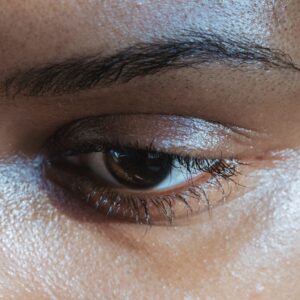 Under eye bags - dark circle treatment- Midas Aesthetics
