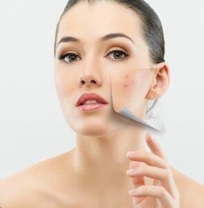 how to prevent acne - Midas Aesthetics