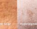 Acne Scars Vs Hyper Pigmentation - Midas Wellness Hub