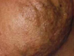 Keloid or Hypertonic Scars - Acne Scars Vs Hyper Pigmentation - Midas Wellness Hub