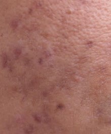 Post Inflammatory Hyperpigmentation - Acne Scars Vs Hyper Pigmentation - Midas Wellness Hub