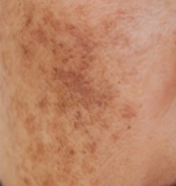 Sun Induced Hyperpigmentation - Acne Scars Vs Hyper Pigmentation - Midas Wellness Hub